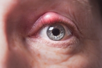 Close up image of Blepharitis or eye inflammation